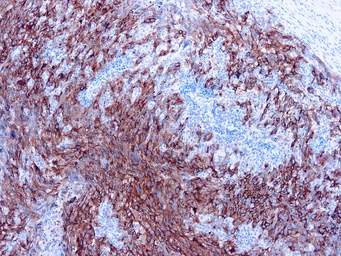 Anti-Melanoma antibody [HMB45+A103+T311] used in IHC (Paraffin sections) (IHC-P). GTX14203