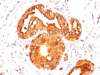 Anti-MUC1 antibody [MUC1/845] used in IHC (Paraffin sections) (IHC-P). GTX34859