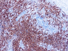 Anti-Melanoma antibody [HMB45+A103+T311] used in IHC (Paraffin sections) (IHC-P). GTX14203
