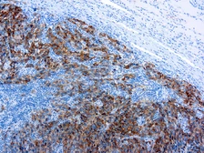 Anti-Melanoma antibody [HMB45] used in IHC (Paraffin sections) (IHC-P). GTX20787